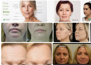 Does Botox Work on Marionette Lines? Botox Health 