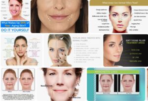Can dermal fillers treat Marionette lines? Botox Health 