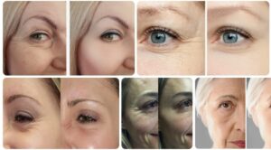 Botox Before and After Eyes, Botox Around the Eyes Guide Botox Health 