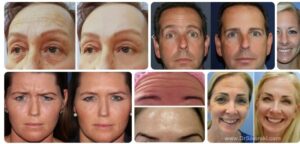 Botox Forehead Before and After Results Botox Health 
