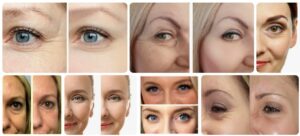 Botox Under Eyes Before and After, Comparison Guide Botox Health 