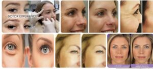 Botox Under Eyes Before and After, Comparison Guide Botox Health 