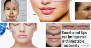 Is Botox or Filler Better for Marionette Lines? Botox Health 