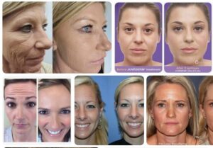 Chin Botox Before and After Guide Botox Health 