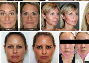 Chin Botox Before and After Guide Botox Health 