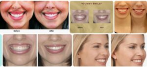Gummy Smile Botox, Treatment, Before and After Injection Botox Health 