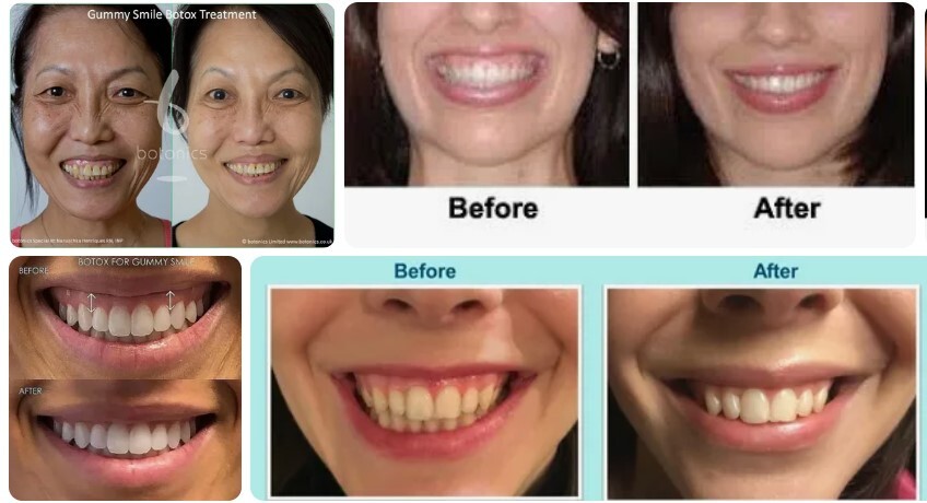 Gummy Smile Botox Treatment Before And After Injection