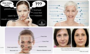 How Many Units Botox for Marionette Lines? Botox Health 